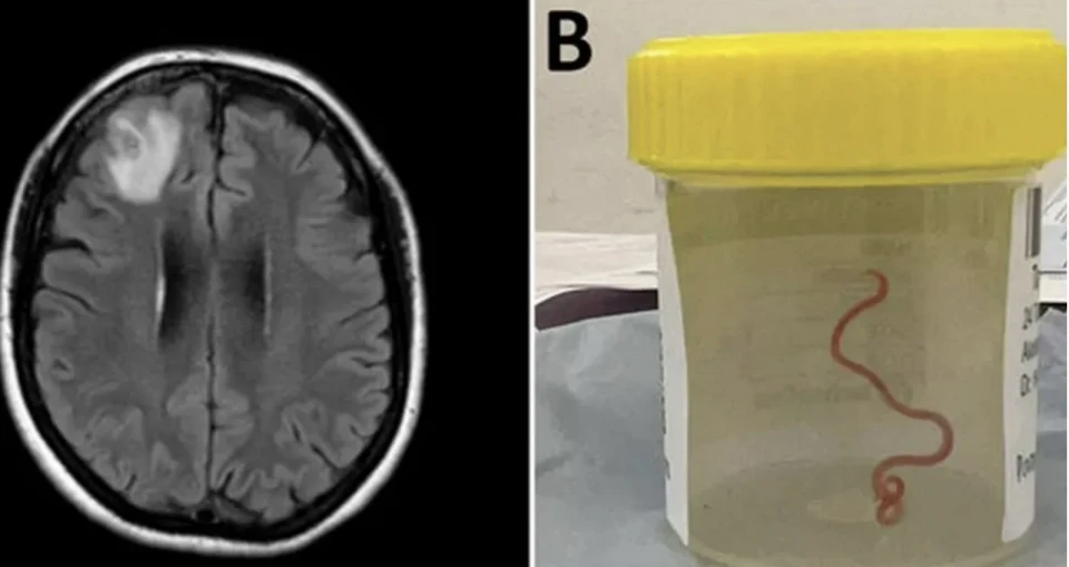 На фото: черв'як у мозку
