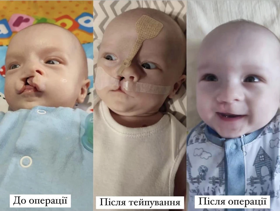 У Львові прооперували немовля із вродженими вадами обличчя