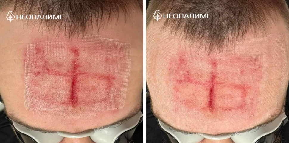 свастика на лобі бійця