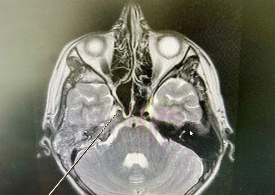 У Львові медики врятували 15-річного хлопця з рідкісним ускладненням отиту