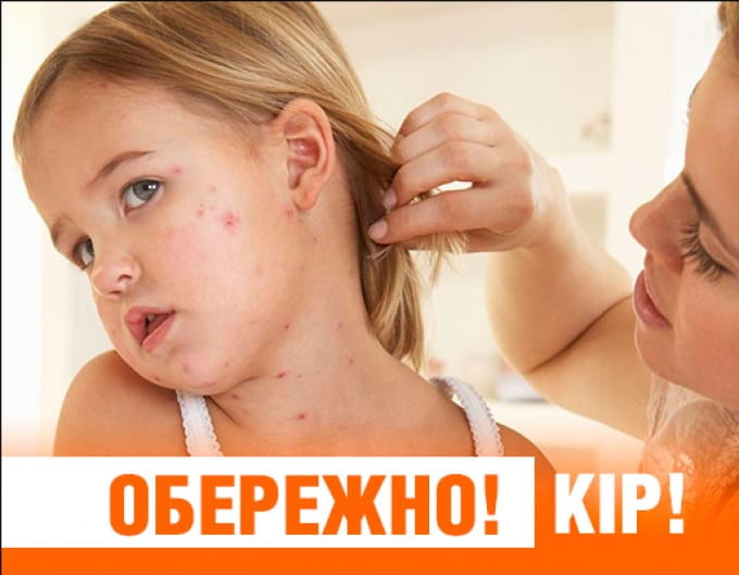 На Буковині через ускладнення від кору померла 10-річна дівчинка