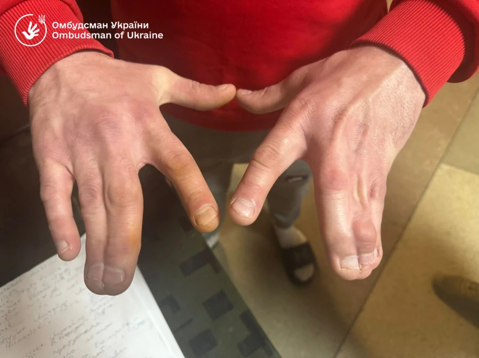 На фото: руки чоловіка з видимою фізичною вадою, якого утримували в Ужгородському ТЦК та СП попри стан здоров'я, зафіксовано під час моніторингу омбудсмана України, 2026 рік